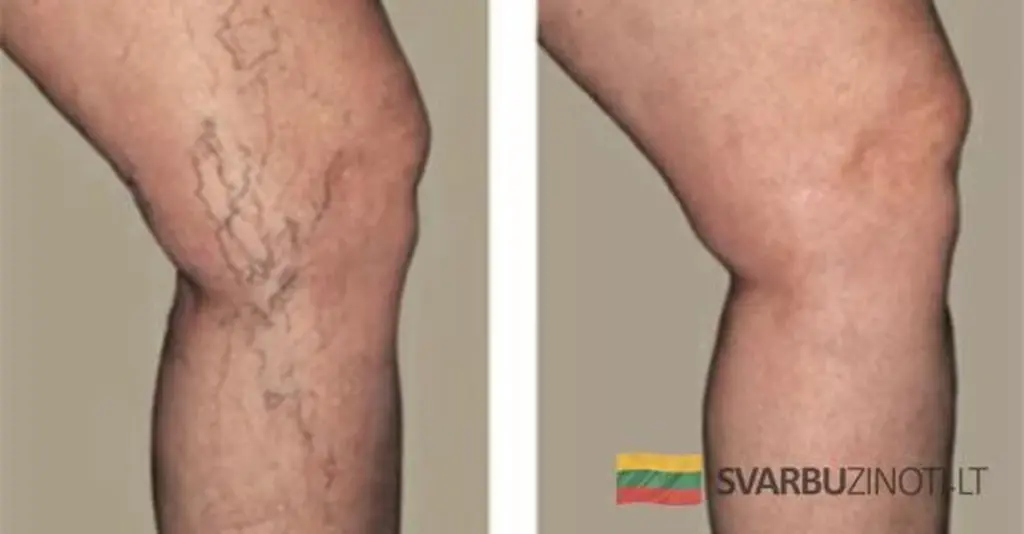 5 klíčů k prevenci křečových žil, které lékaři opomíjejí